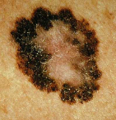 Superficial spreading melanoma